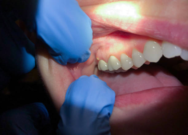 Best Emergency Tooth Extraction in Jnstown, OH
